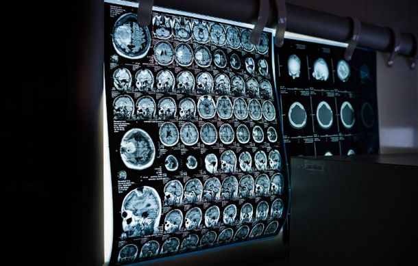 Enfermedades neurológicas